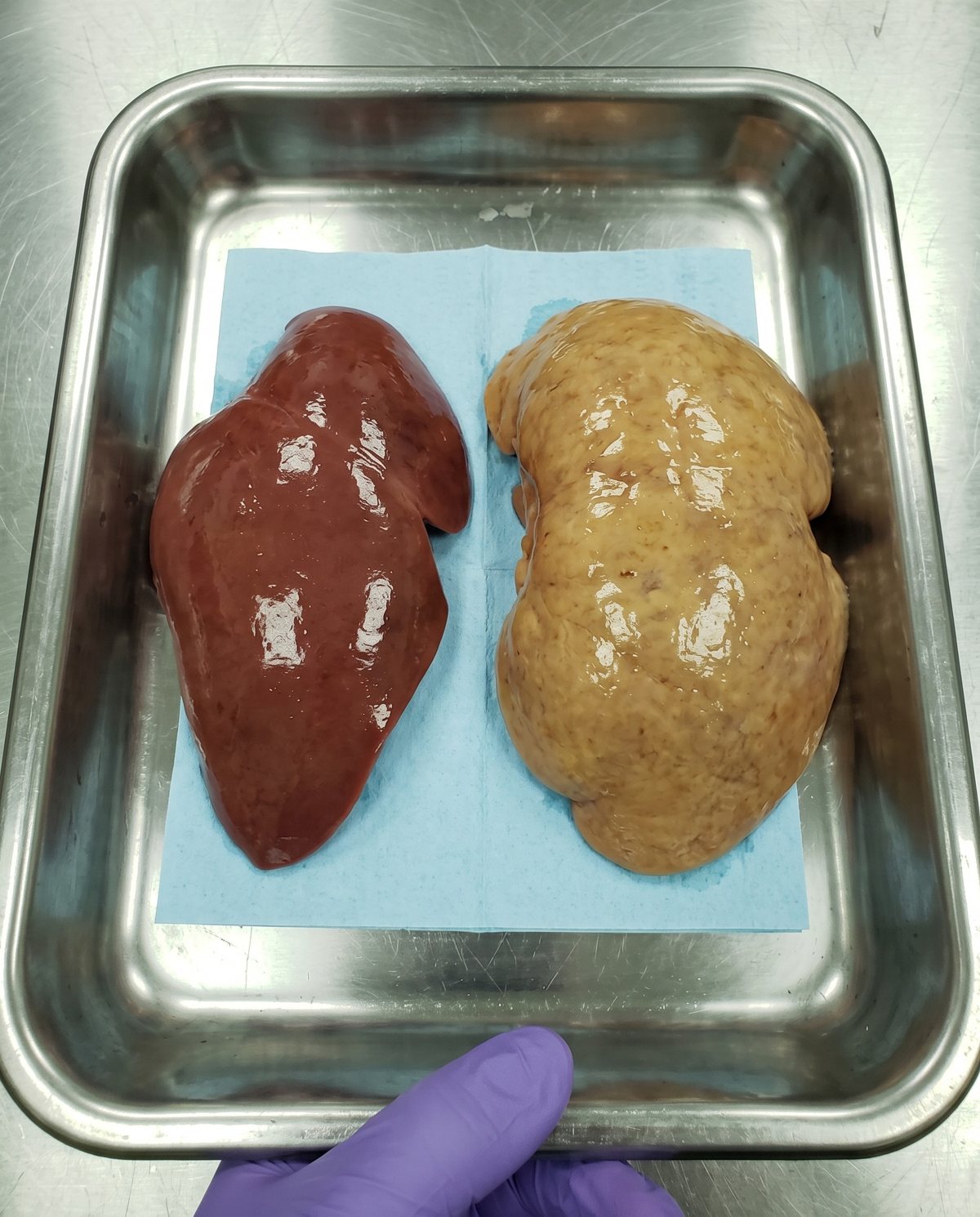 A healthy dark-red liver next to a pale, swollen fatty liver on a steel tray