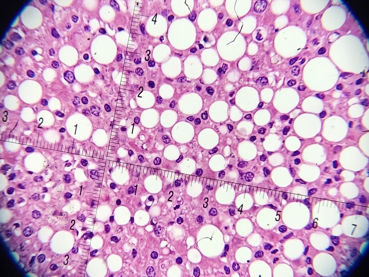 Fatty liver tissue seen through a microscope, with round white spaces among pink cells